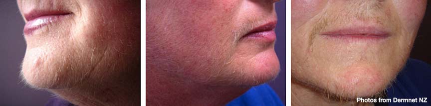 Hirsutism photos